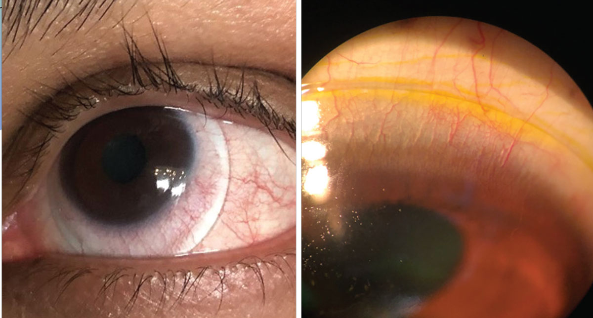 Blanching at the lens edge (left) and fluorescein seepage superiorly in a scleral lens due to edge lift off (right).
