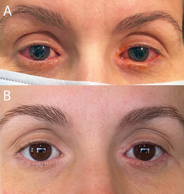 Fig. 1. (A) Initial clinic visit reveals bilateral conjunctival injection, epiphora and blepharitis. (B) Patient-provided photograph with significant improvement three months after initiation of dedicated ophthalmic therapy.