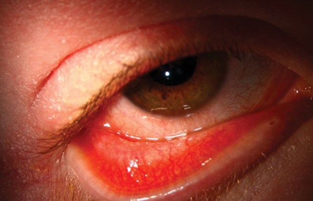 Fig. 2. This 17-year-old male with severe atopic dermatitis was started on dupilumab. There was a marked skin improvement which he called “life-changing,” but shortly thereafter he developed itching, redness, epiphora, photophobia and ocular discomfort. The clinical exam revealed bulbar and palpebral conjunctival injection with a mixed papillary and follicular response, punctate erosions and filamentary keratitis.