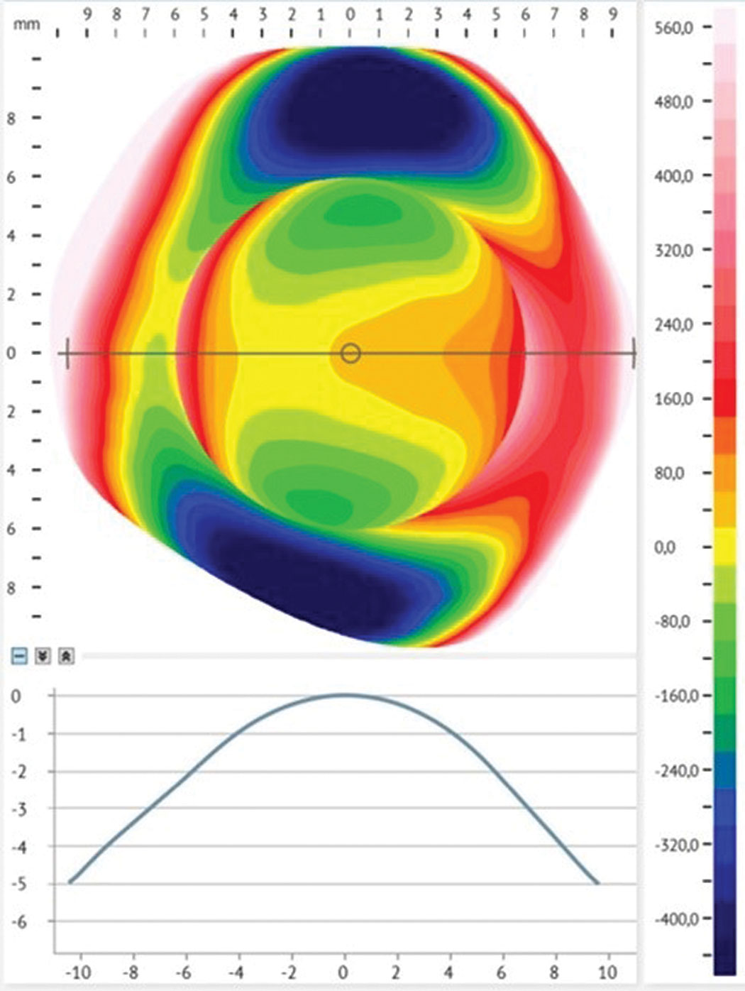 Fig 1. Profilometry of the conjunctiva shows irregular toricity of more than 450 um.