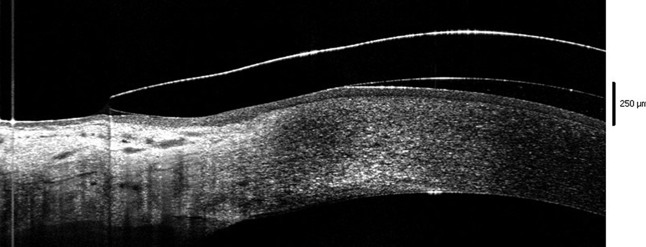Fig 2. Edge of the lens lifting off the conjunctival surface.