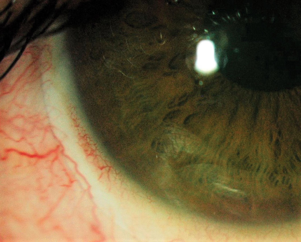 Fig 4. Conjunctival compression with blanching.