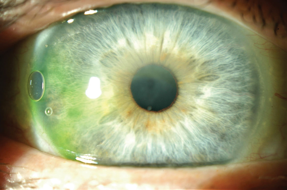 Fig 5. Corneal edema is visible under the scleral lens.