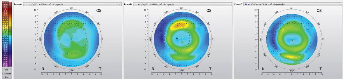 Fig. 3. Pre-ortho-K treatment corneal topography (left), one week after starting ortho-K (center), topography after modifying lens to have a toric landing zone (right).