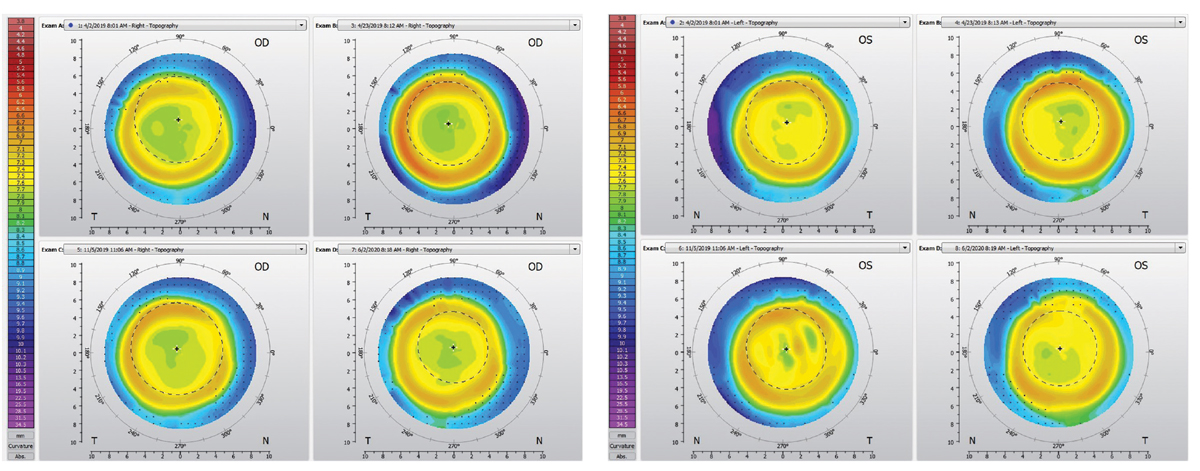 Figs. 7 and 8. Changes in corneal topography over the course of treatment OD (left) and OS (right), that includes one-week follow-up (top left corner of each figure), two-week follow-up (top right), six-month follow-up (bottom left) and one-year follow-up (bottom right).