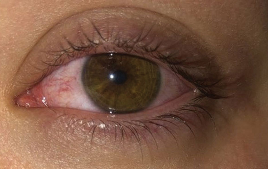 This patient slept in their contact lenses and woke up with acute redness and pain. They were subsequently diagnosed with CLARE. Note the prominent redness OS.