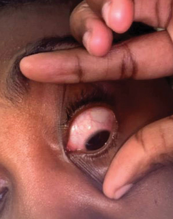 A patient who presented with an irritated, painful eye after sleeping in her contact lenses was diagnosed with unilateral CLARE.