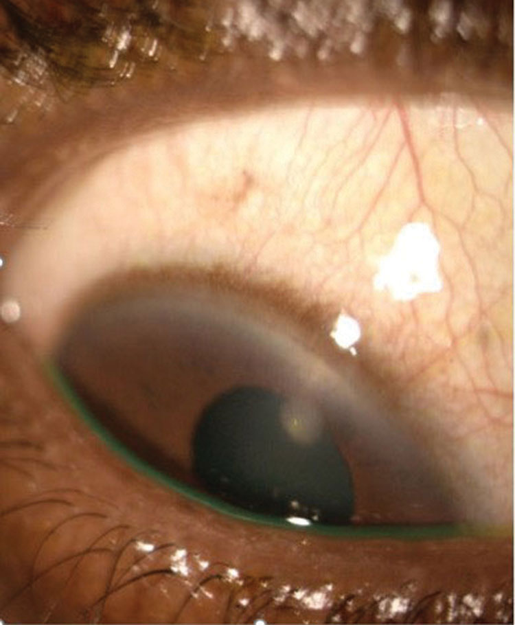 This patient was diagnosed with a CLPU with minimal corneal staining overlying the infiltrate.