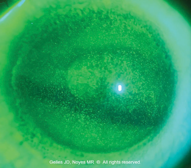 Fig. 2. Toxic keratopathy due to soft lens solution in the scleral reservoir.