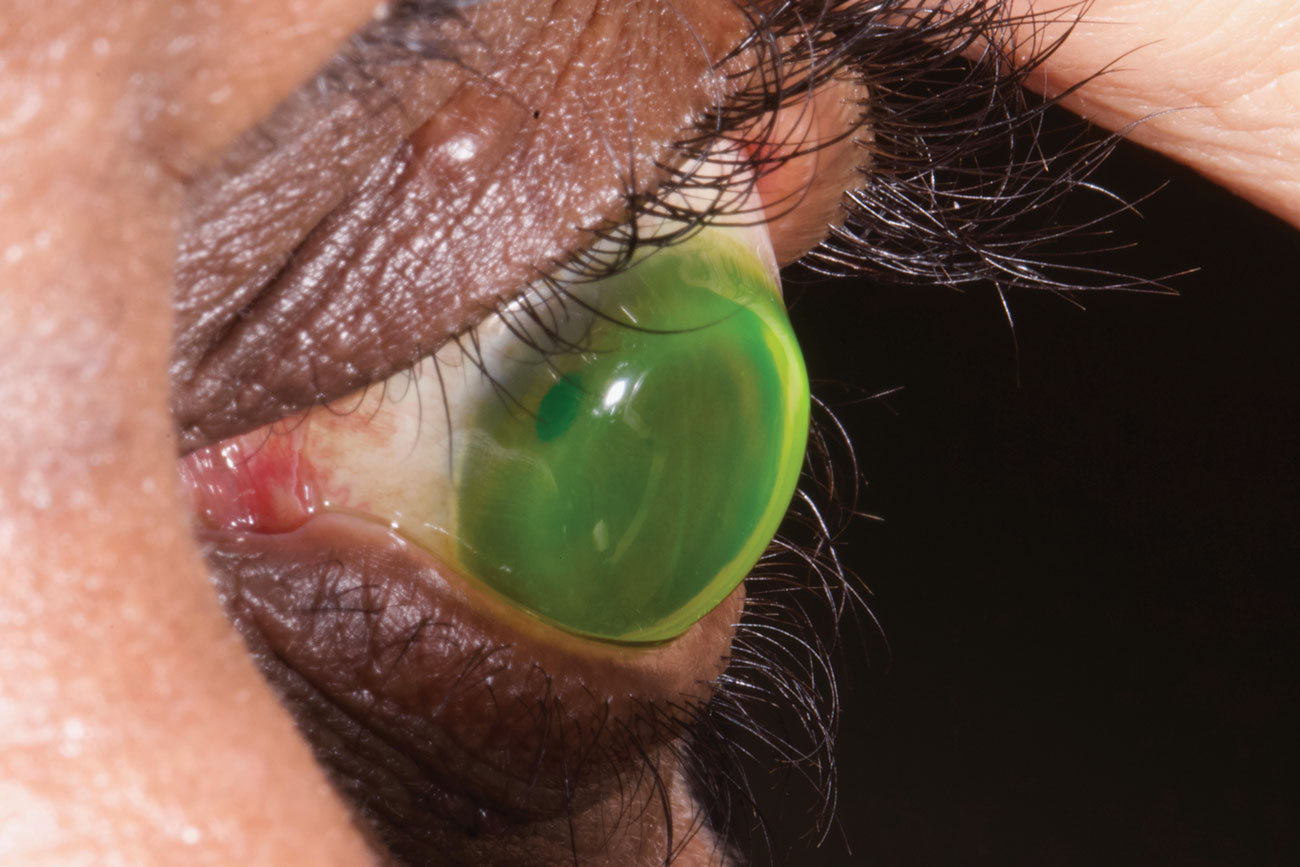 A 19mm scleral lens with sodium fluorescein fit on an eye with a 25-year-old proud graft fit.