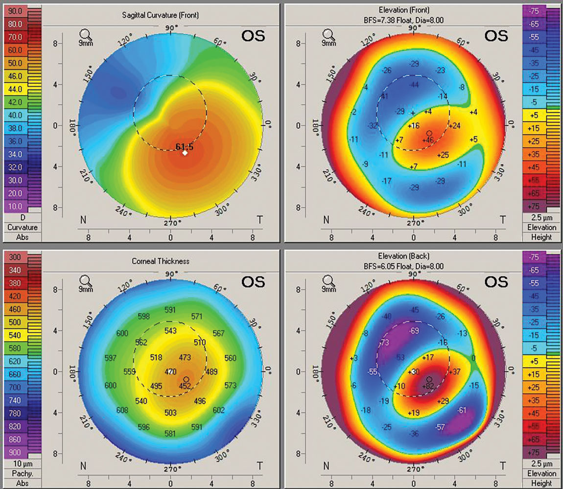 Having access to corneal topography and tomography is essential for achieving the best fit with custom-designed lenses for keratoconic eyes.