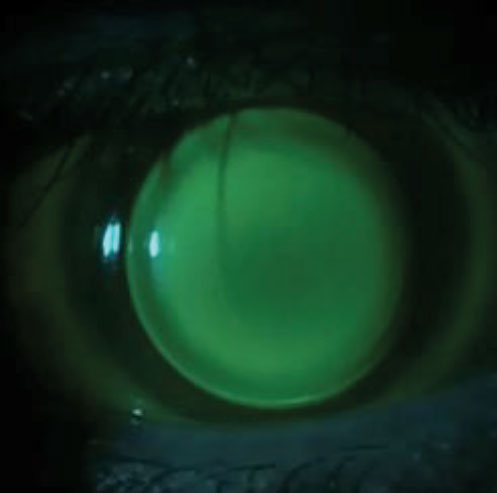 Slit lamp photo and OCT of an ideally fit hybrid lens on a keratoconic eye.