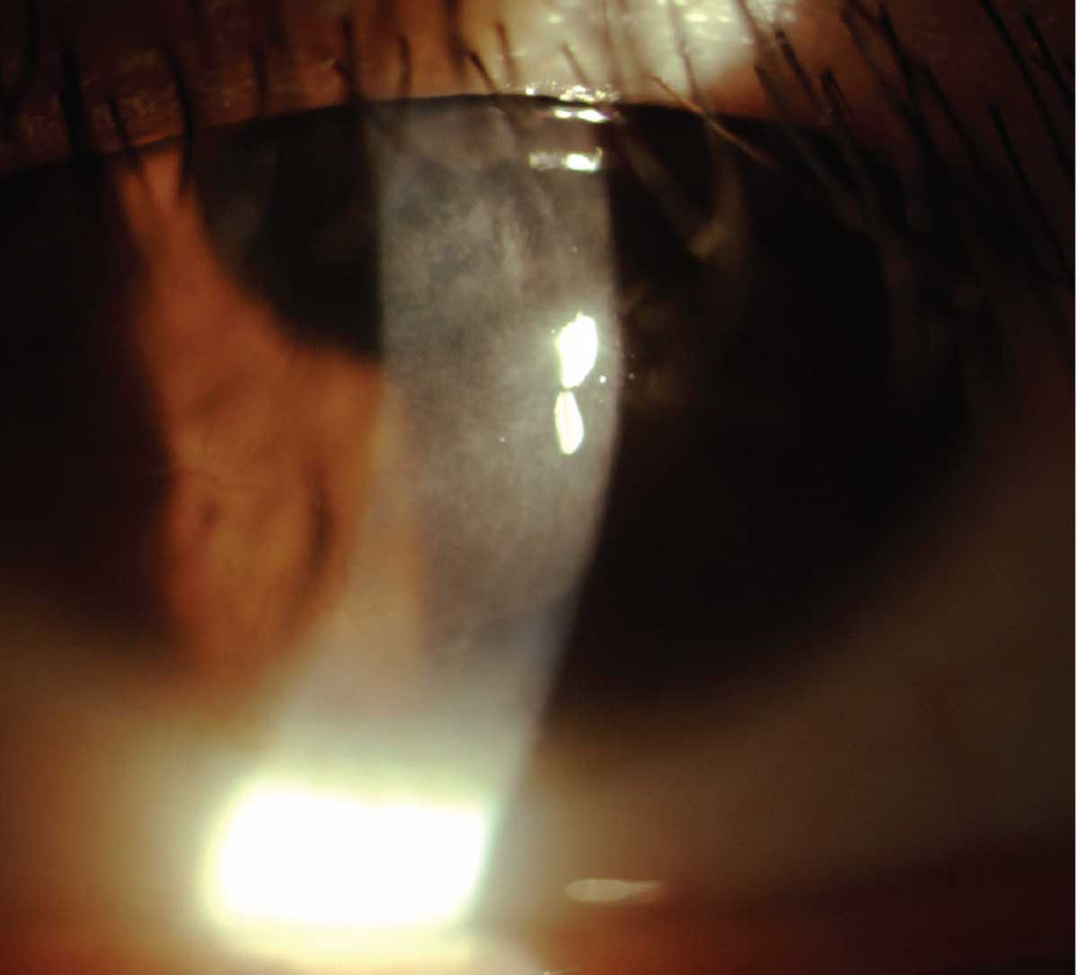 Fig. 1. A well-centered, empirically designed orthokeratology lens is evaluated on-eye at the dispensing visit. The sodium fluorescein dye is absent in the central treatment zone and midperipheral alignment curves.