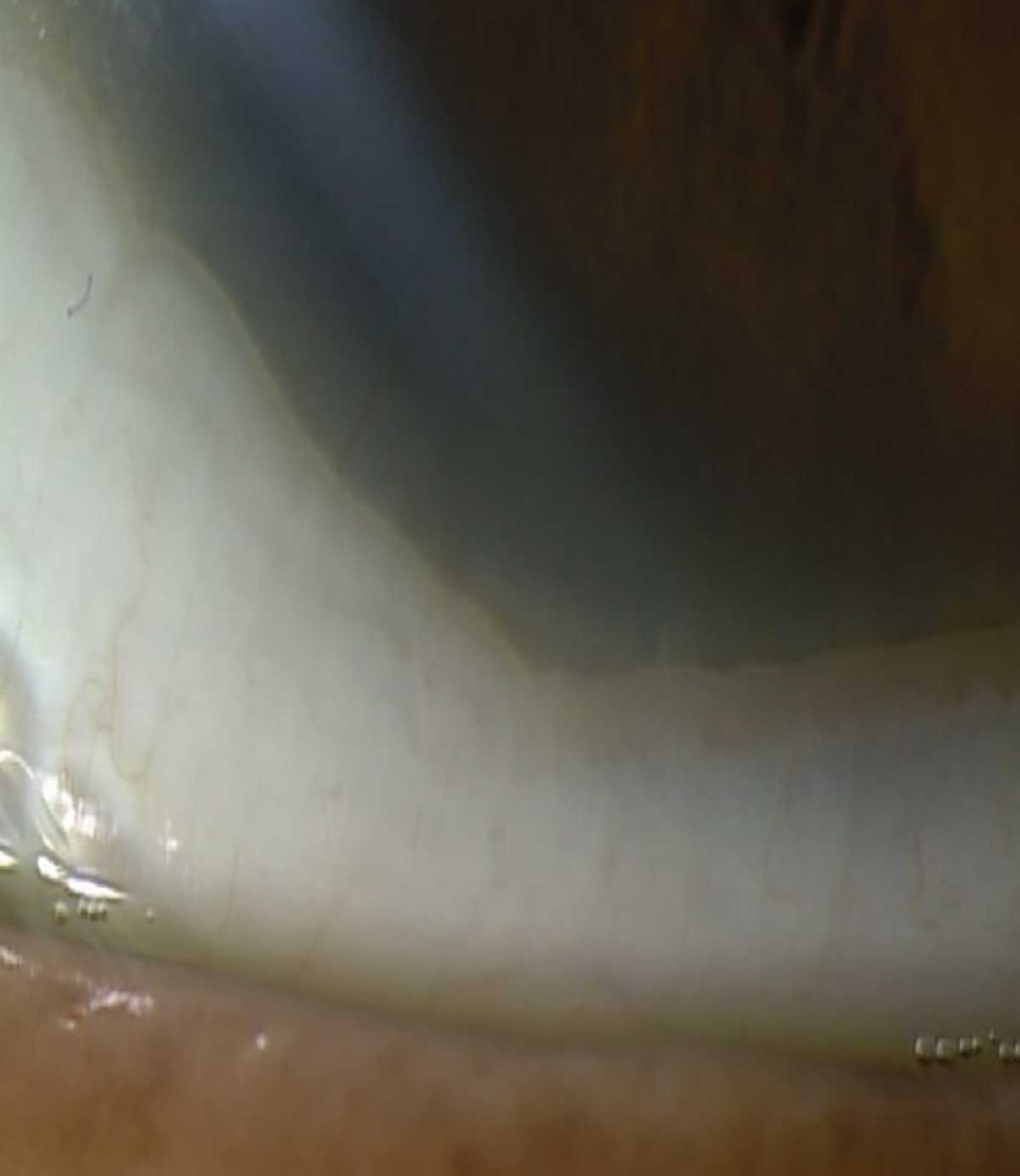Fig. 4. Patient with scleral prolapse, which was resolved with the assistance of a laboratory consultant. This image was uploaded to the lab’s web consultation tool, along with other fitting data, and they replied via email with suggested changes to the fit, which included reducing the lens diameter.