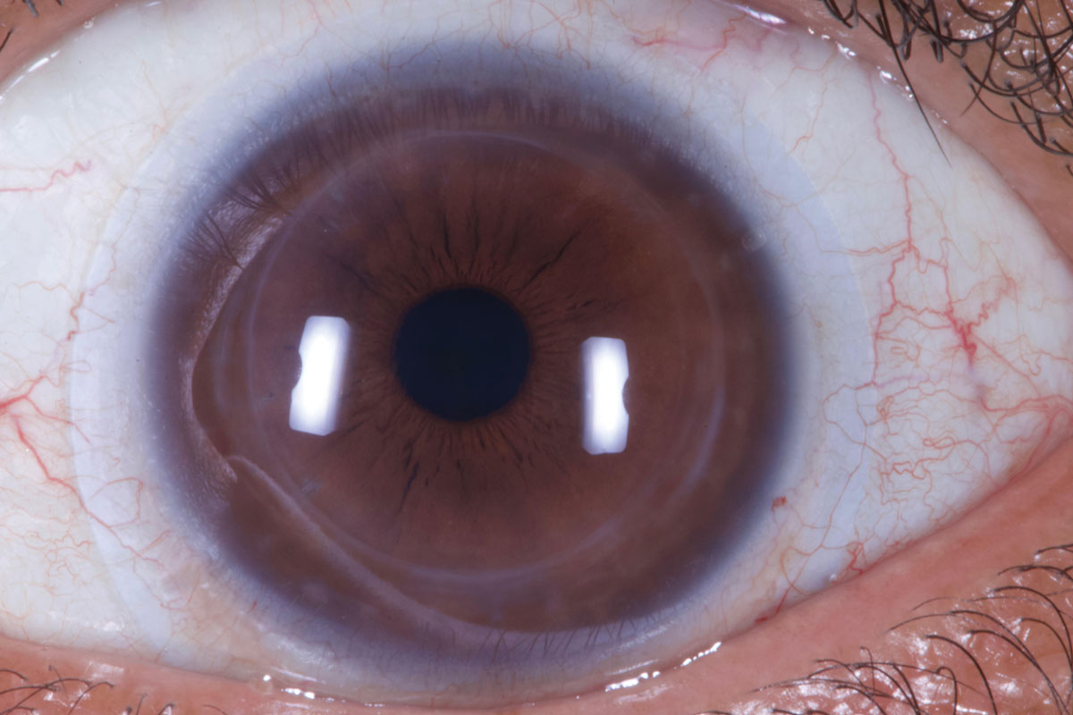 A scleral lens over an eye post-ICRS.