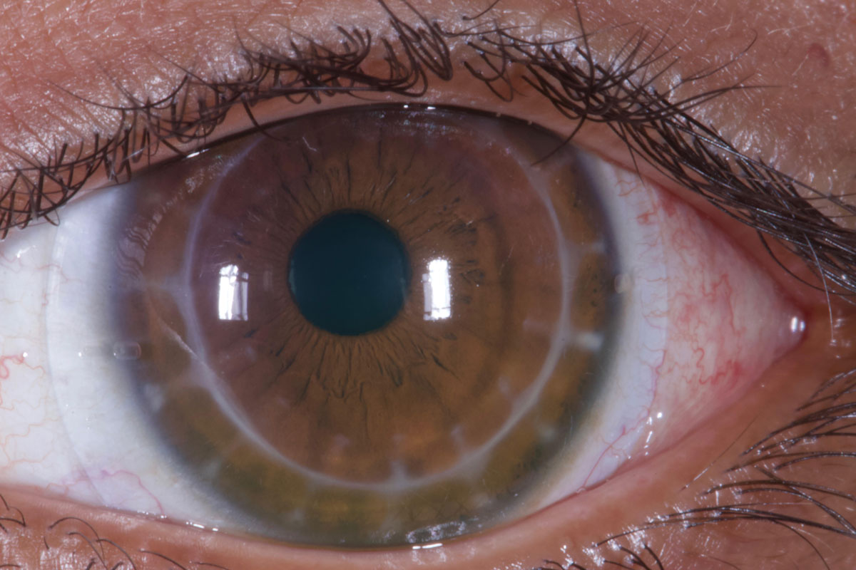 A well-fit scleral lens over an eye that has undergone a corneal transplant.
