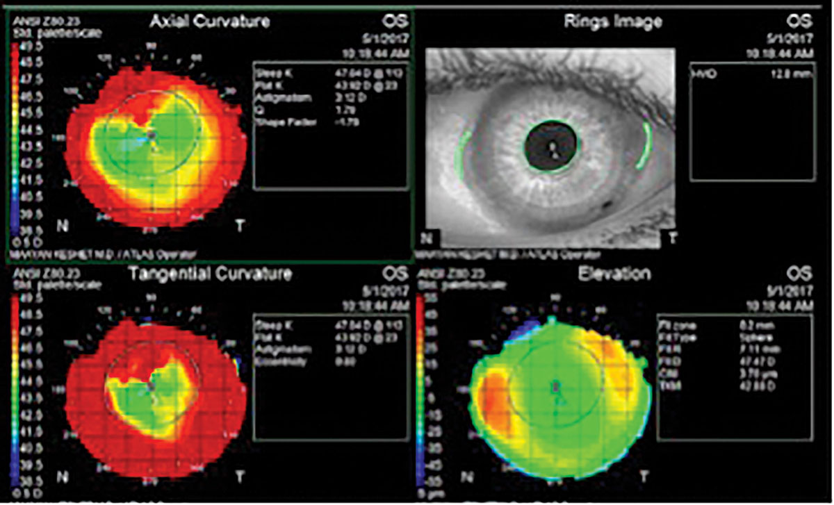 Topography shows relative central flat and steep periphery (reverse geometry) in a post-PK cornea. This patient was fit into an oblate-shaped (steep skirt) hybrid lens.