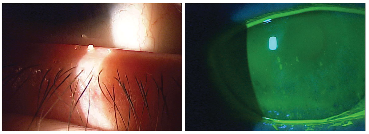 Evaporative DED, a consequence of MGD (left), and aqueous-deficient (right), are the two primary types of dry eye.