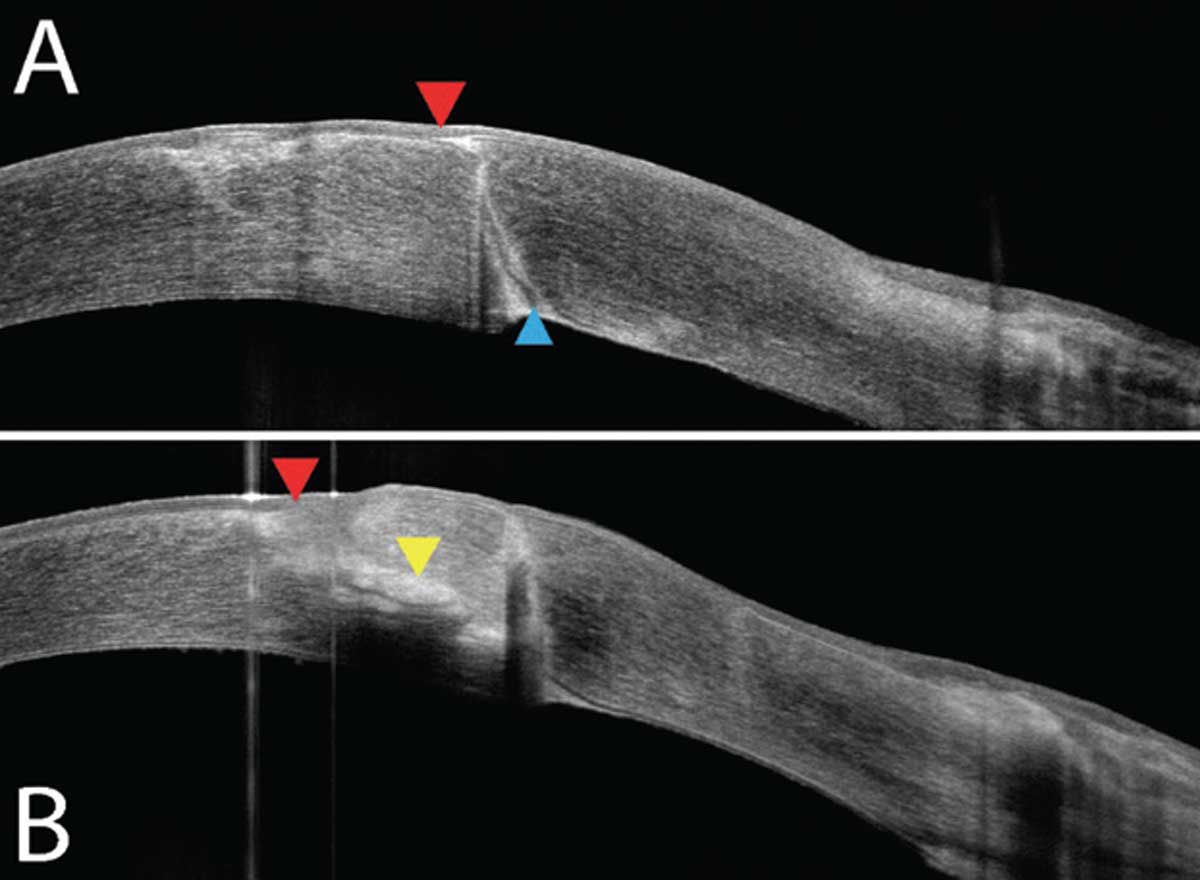 Fig. 2. (a) OCT of the graft-host junction superior to the infiltrate shows a fully intact epithelium (red) and a delineated graft-host barrier (blue). (b) OCT over the lesion demonstrates intact corneal epithelium (red) with a midstromal opacity/infiltrate (yellow).