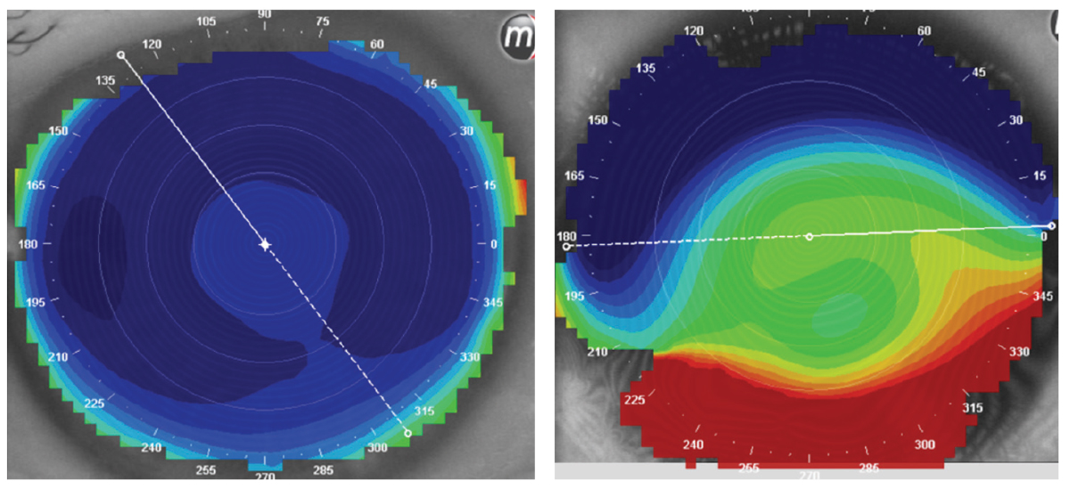 Elevation maps of two different patients. Both have a reference sphere, from which the maps were created. The patient on the left has a very uniform elevation and was successfully fit with a spherical GP. The patient on the right has a very irregular elevation pattern and, with the scar in the inferior cornea, could only be fit with a very customized scleral lens. Nothing would stay on the eye without falling off.