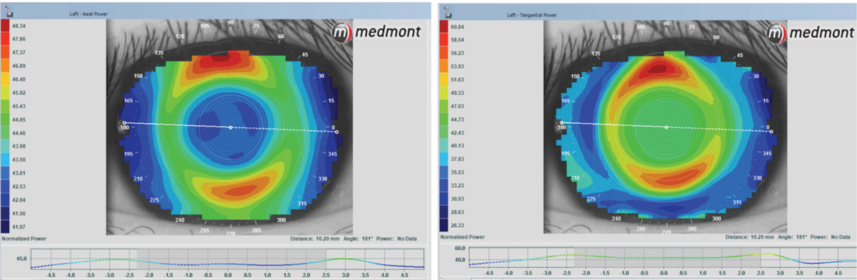 The left image is an axial map of an ortho-K patient with a great fit, great vision and much happiness. The right image shows the tangential map, which defines the edges of the cornea and shows a complete ring of treatment around the central treatment zone. The tangential map gives us a clear, complete picture of what is going on with this ortho-K fit.