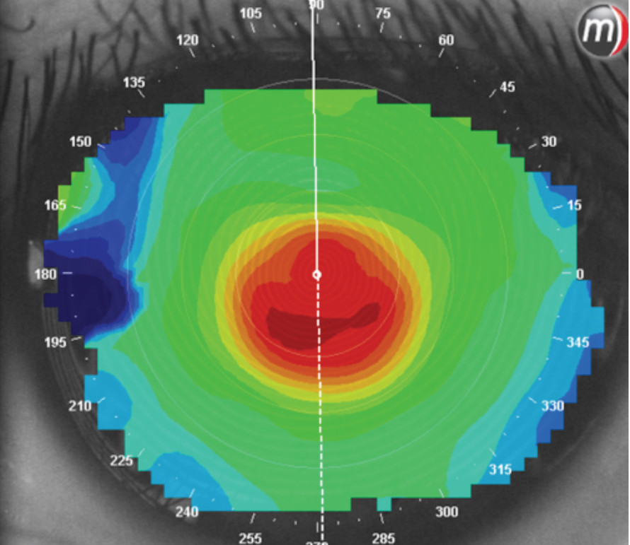A central cone that signals a highly prolate cornea.
