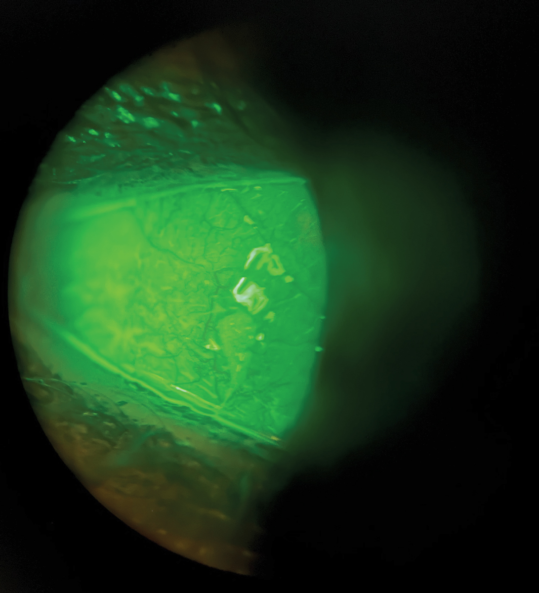 Fluorescein staining in allergic conjunctivitis with dry eye.