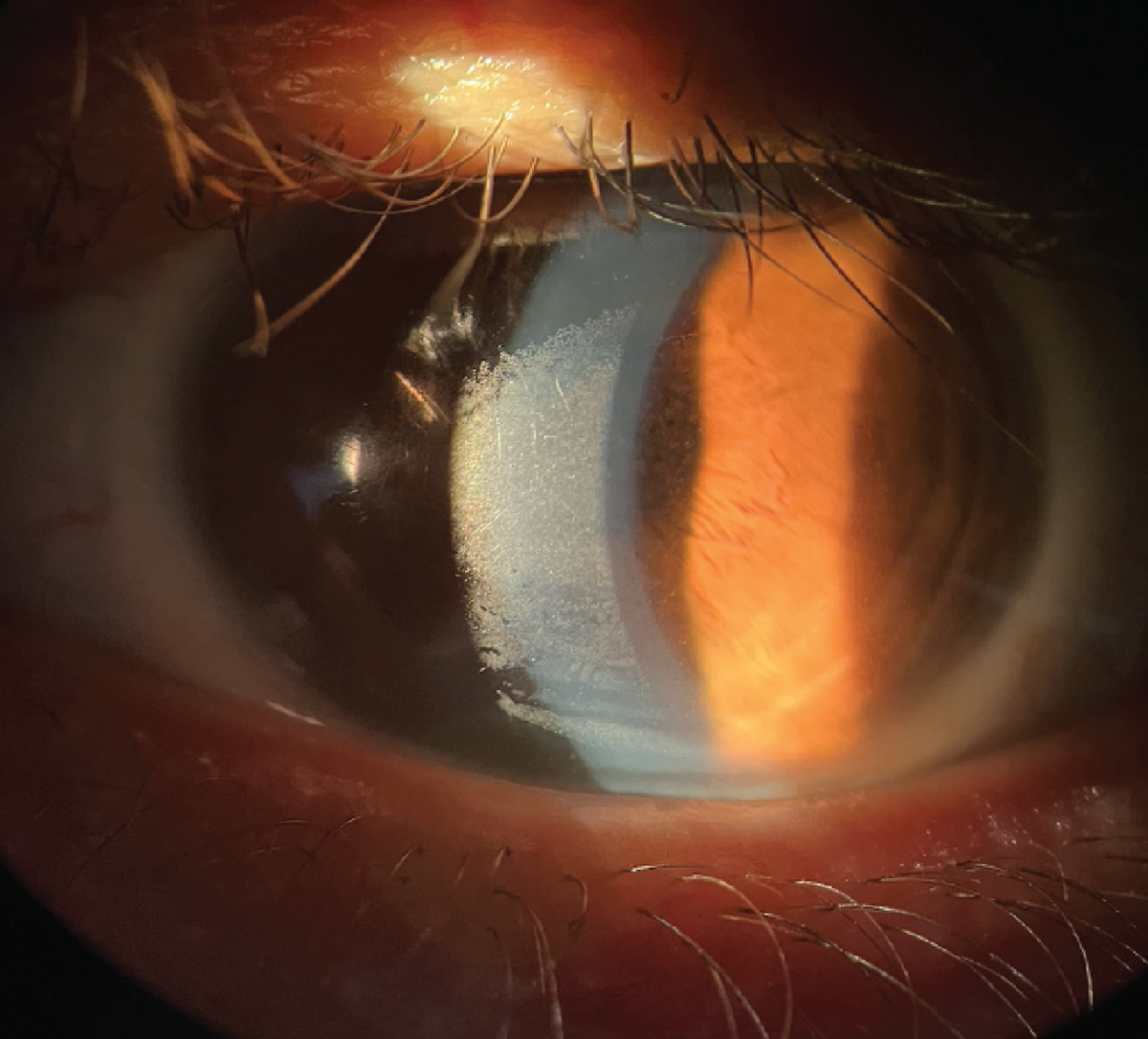 Build-up on a scleral lens surface can form from a poor tear film.