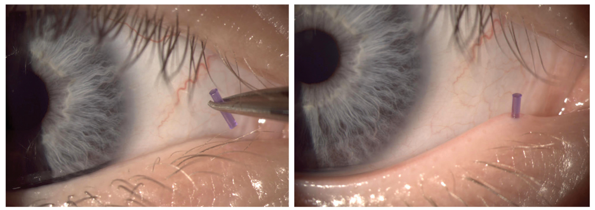 Fig. 2. Placing punctal plug in a lagophthalmos patient to increase tear volume.