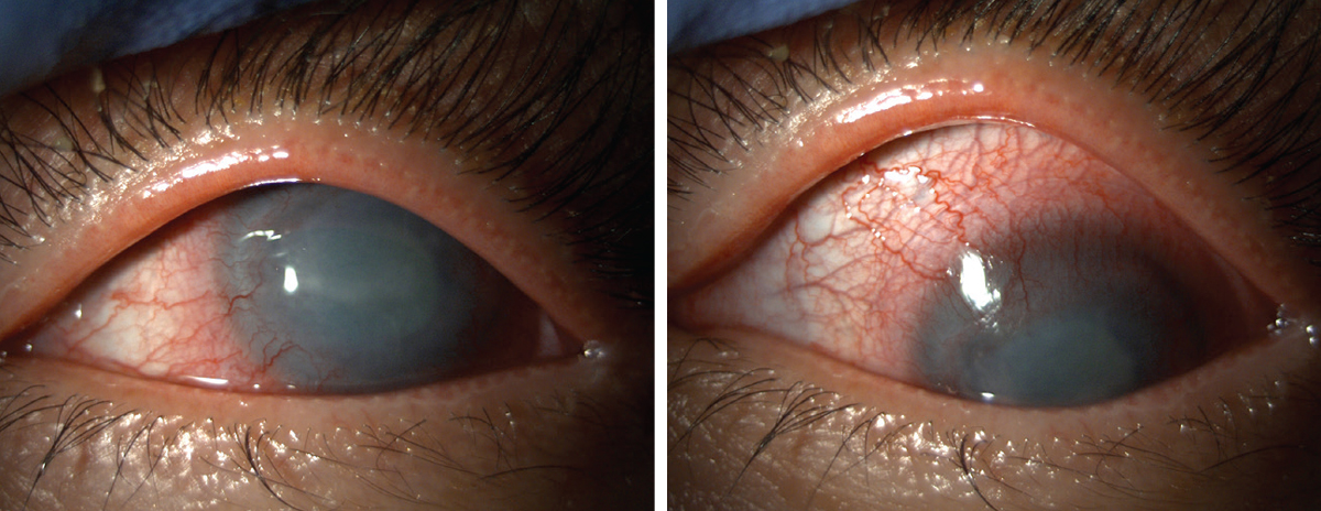 Fig. 1. Acanthamoeba and conjunctival injection shown in our patient.