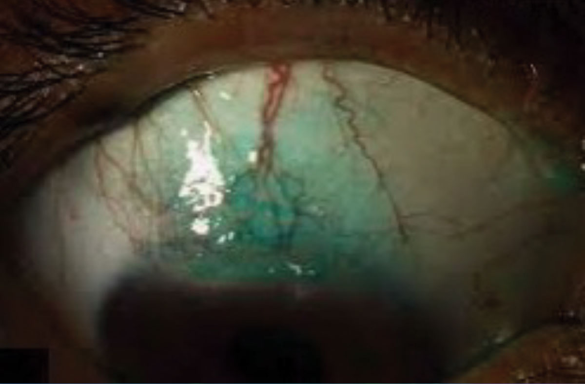 Pictured here is a 3+ lissamine green stain on conjunctiva from dry eye.
