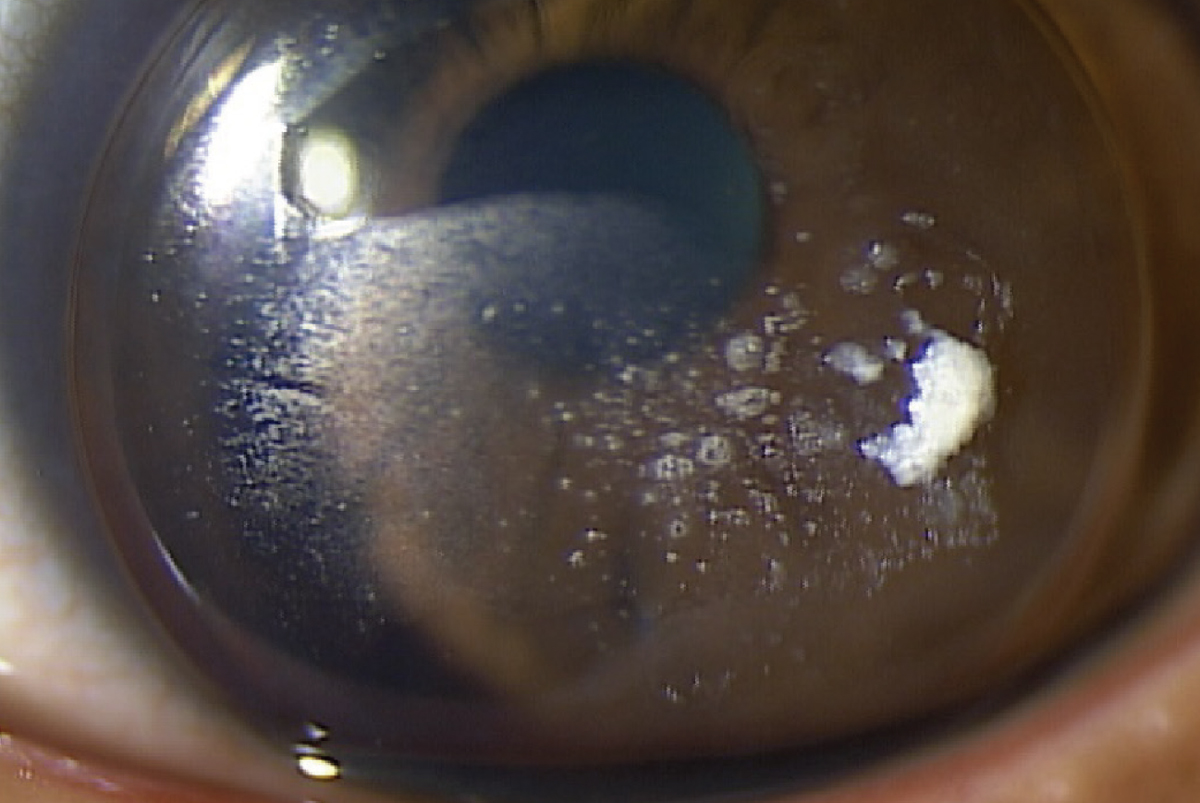 Fig. 3. Assortment of lens deposits OS found in case two, which were not improved after extensive in-office lens cleaning. Lens replacement was recommended.