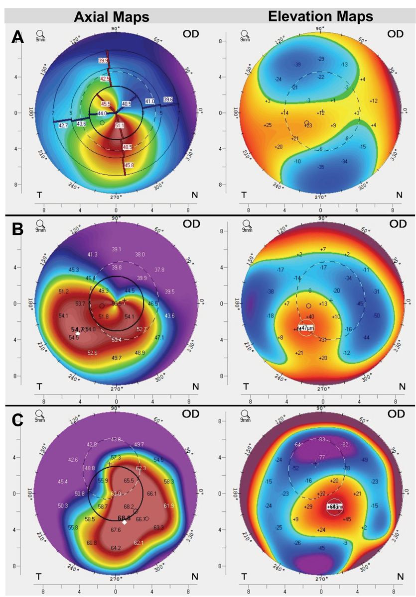 Fig. 1. Assess corneal elevation maps for scleral lens suitability. Here, corneal topography from three patients with irregular astigmatism shows one patient (A) with relatively mild elevation differences (~60um) and a relatively symmetric shape. Another patient (B) shows moderate elevation differences (~95um) as well as greater asymmetry, and a third patient (C) with severe elevation differences (~150um) as well as high amounts of asymmetry. Our rule-of-thumb is that if there is greater than about 90um of elevation differences between peak and trough on the cornea, scleral lenses should automatically be the priority choice. While all of these patients could be good candidates, patient B and C are particularly indicated due to high asymmetry and elevation differences on the anterior cornea.