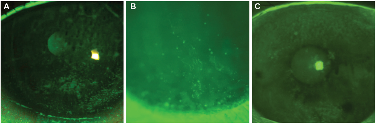 Fig. 2. In corneal staining post-lens removal, punctate staining is often observed after scleral removal, seen in a post-transplant patient (A) and to a lesser extend in a keratoconus patient (B). Epithelial bogging (C) is also a common finding that does not appear to have any adverse effect on the cornea but is not well understood. Each example was within the normal acceptable range for these patients but underlies the importance of baseline testing to monitor changes in staining.