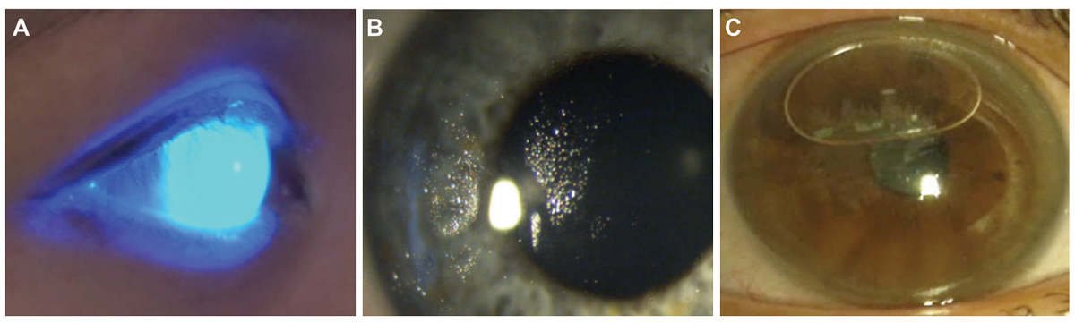 Fig. 3. When using sodium fluorescein for an initial assessment of a scleral lens on the eye, a widefield, low mag view of the lens in cobalt blue light (A) will allow a first view of the lens fit, which appears adequate here with no areas of darkness that would indicate touch or a bubble. This can be observed using a slit lamp or using a handheld light source. Non-wetting lenses (B) and application bubbles (C) are common and can often be viewed outside of the slit lamp. Both indicate that a lens should be removed, reconditioned if needed, and reapplied carefully.