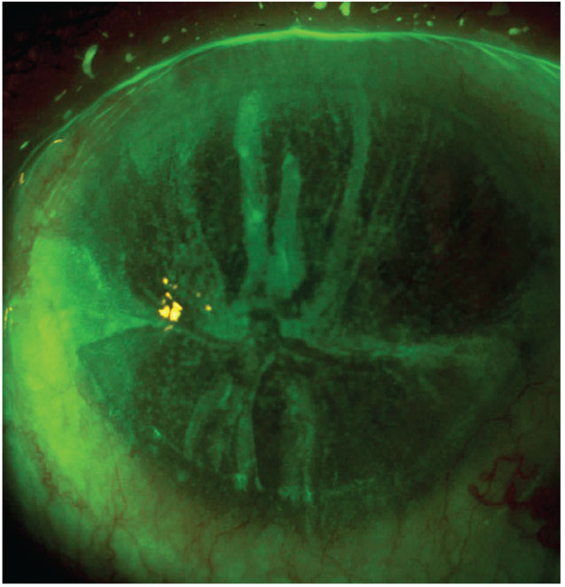Fig. 1. This patient has fluorescein staining with an evident whorl pattern.