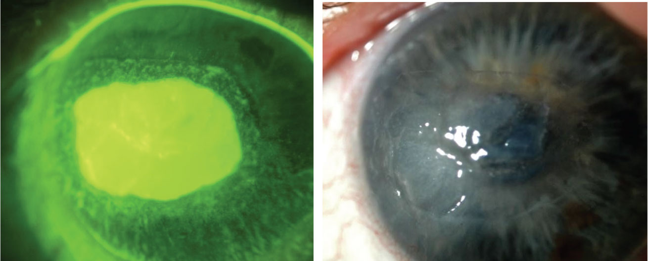 One study reported treating longstanding retinal pigment epithelial detachment with extended-wear scleral lenses using moxifloxacin in the scleral lens reservoir, and none of the eyes developed microbial keratitis.