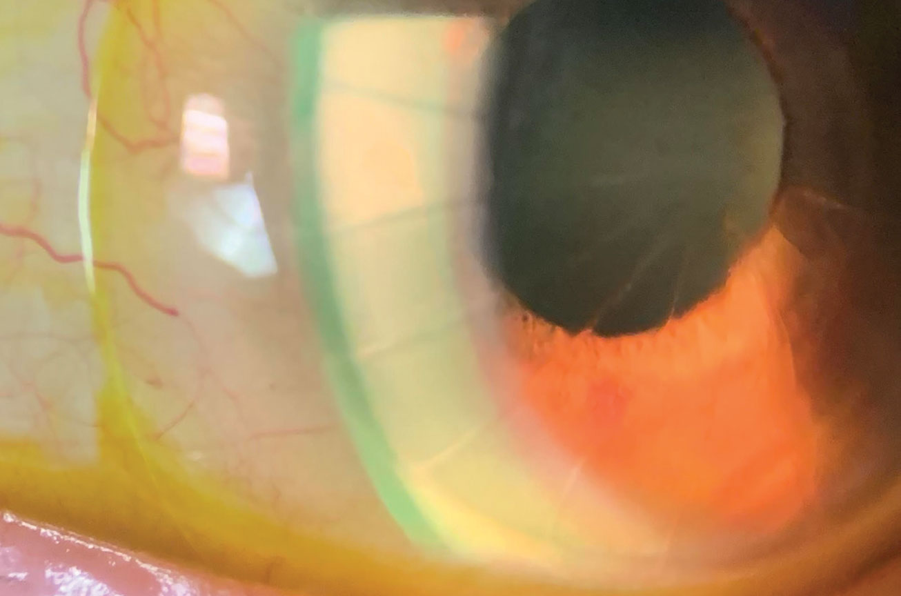 Studies have reported on the use of anti-VEGF agents in the bowl of a scleral lens to treat corneal neovascularization.