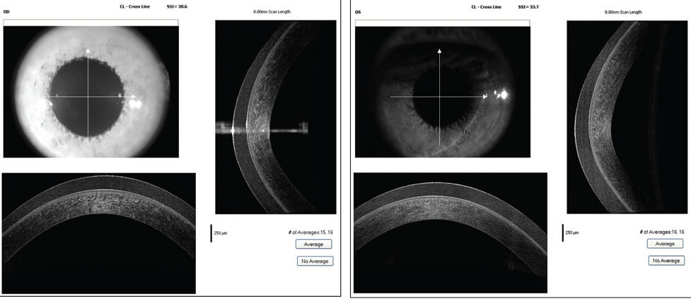 OCT cross-section of the patient’s right and left cornea while wearing the custom soft lenses. 