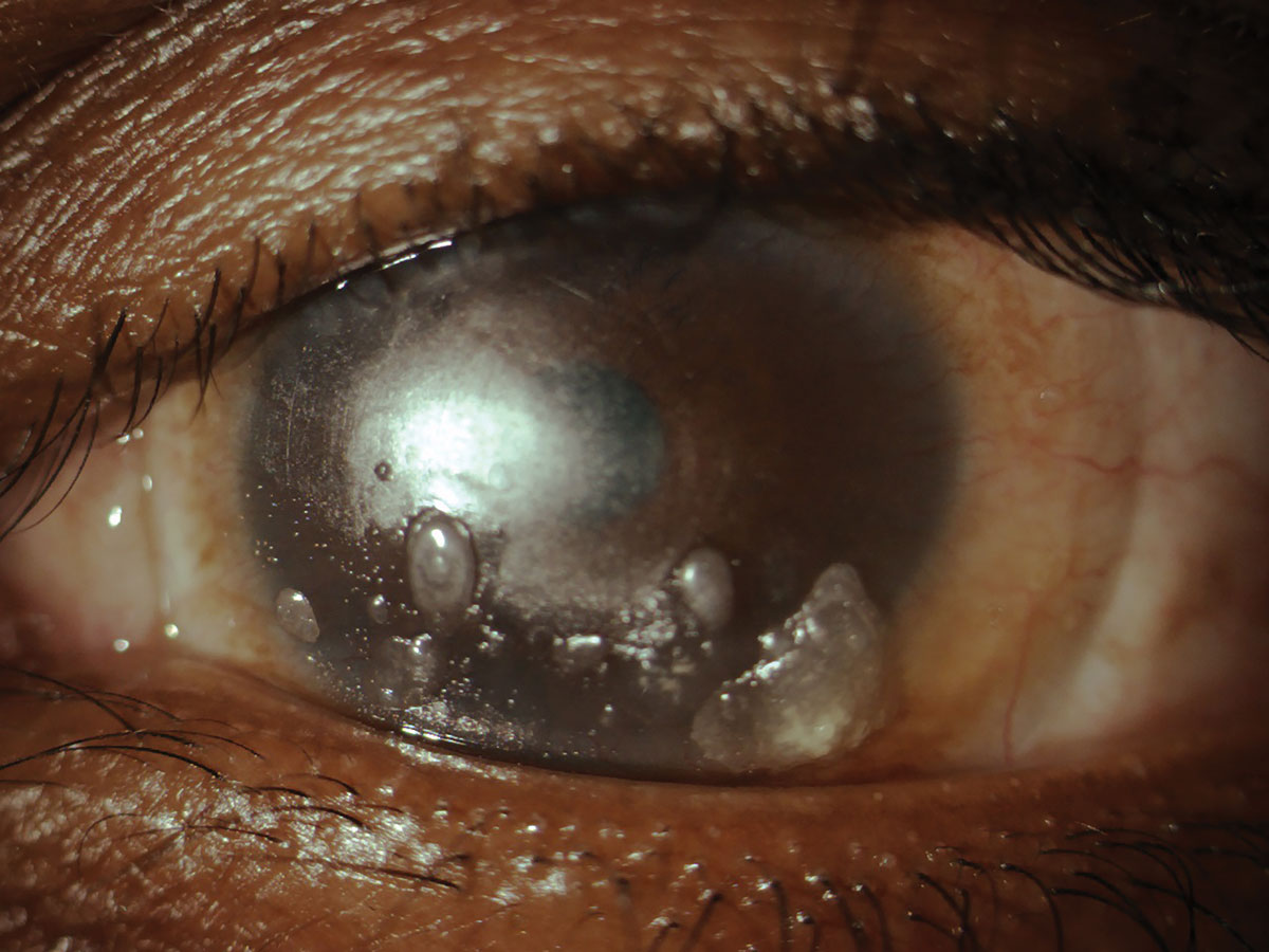 Fig. 1. Heavily deposited soft toric contact lens. 