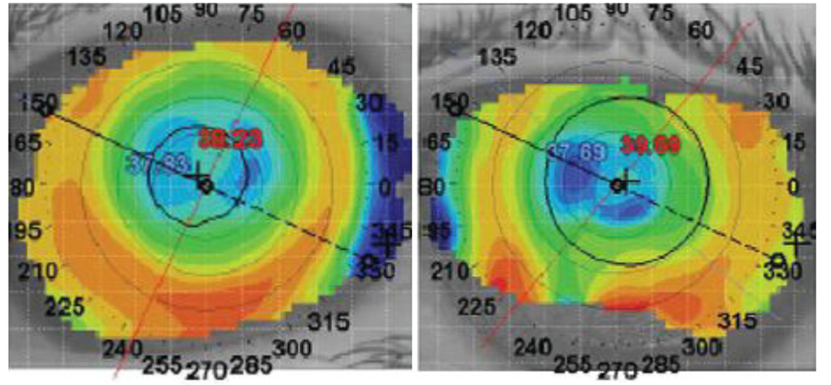 Fig. 2. Topographical images of the right (left) and left eye (right). 