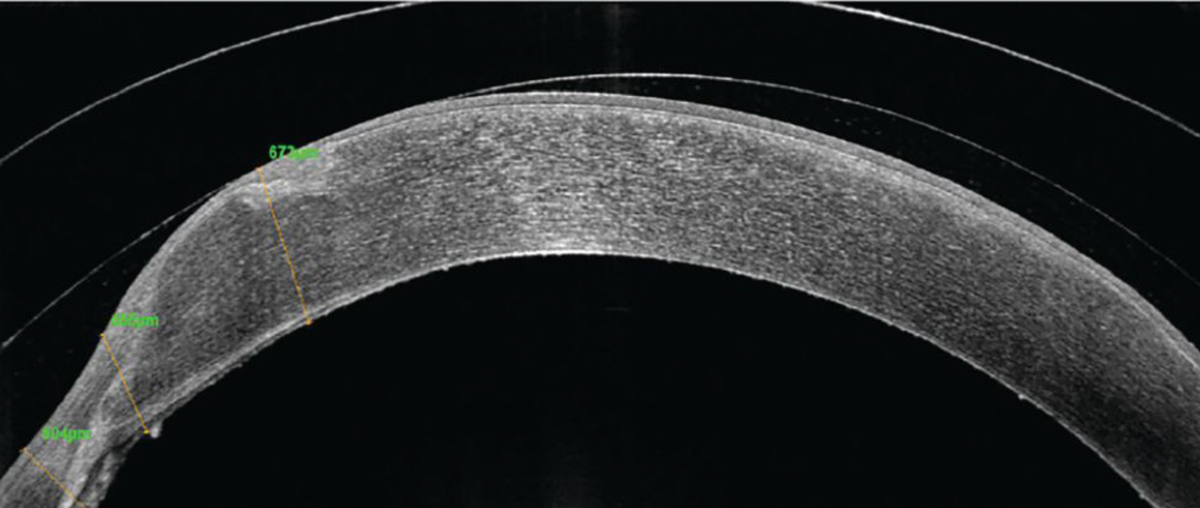 Fig. 9. OCT imaging of the left eye with scleral lens wear shows nasal touch on the graft tissue.