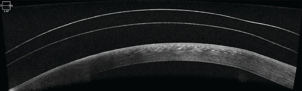Fig. 6. OCT imaging of the patient’s left eye shows good central clearance over the corneal surface.