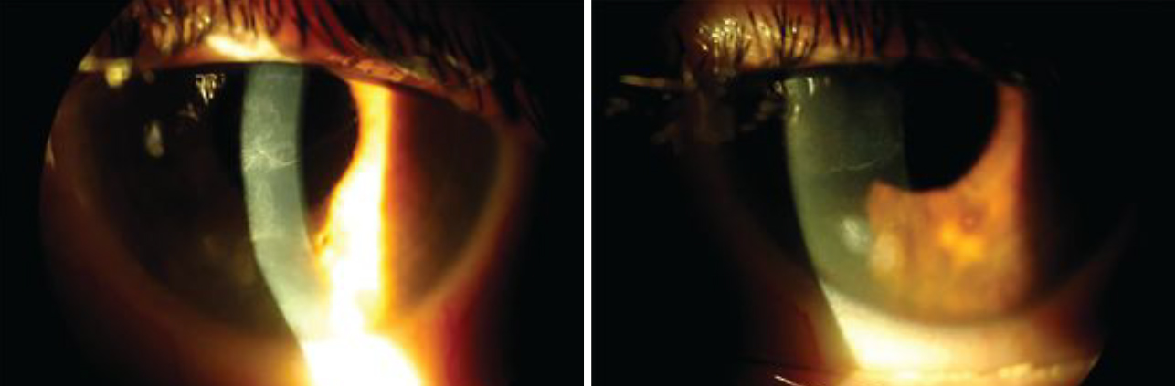 Fig. 1. Slit lamp images of the left eye show central haze on the corneal surface from recurrent epithelial defects and EBMD (left). The image on the right shows a Salzmann’s nodule located inferior nasally on the left eye.