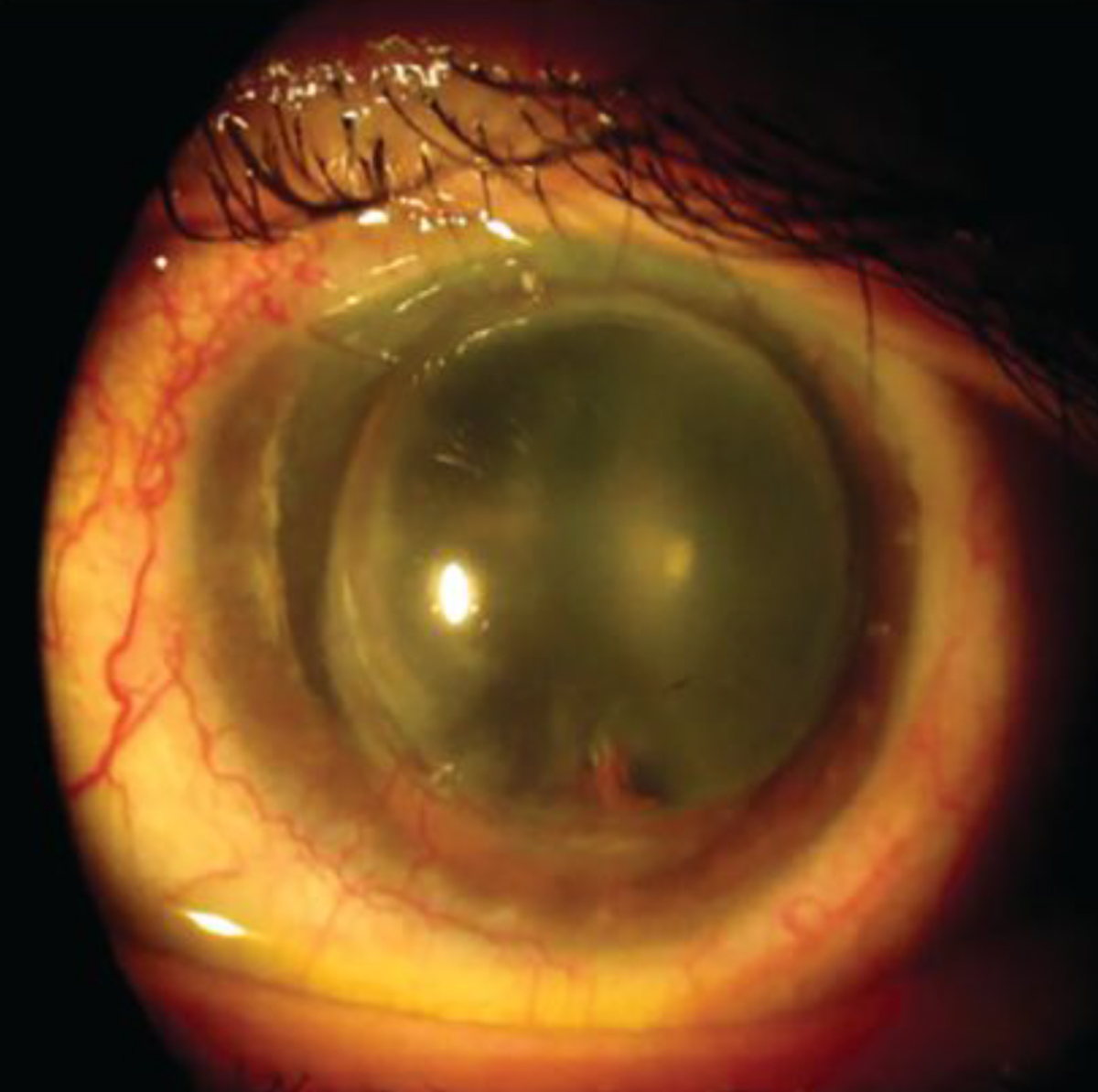 Fig. 7. A steeper profile inferior nasally in the left eye post-PKP.