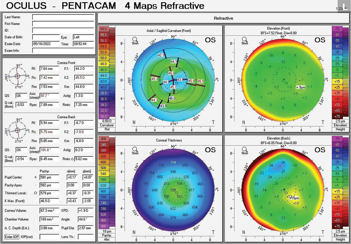 Fig. 4. Pentacam of patient from Case A with a history of a corneal ulcer infection OS resulting in a central corneal scar. The depressed corneal scar can be appreciated with the axial curvature map.