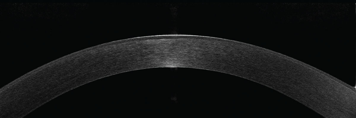 Fig 6. Anterior segment OCT reveals a subtle stromal haze centrally. The overlying scar is not well depicted. Due to the location of this opacity lying within the anterior third of the cornea, it would respond well to PTK.