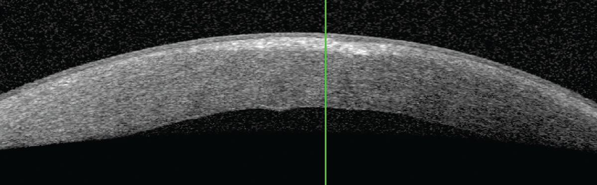 Fig. 7. Anterior segment OCT of the left cornea with visually significant stromal haze.