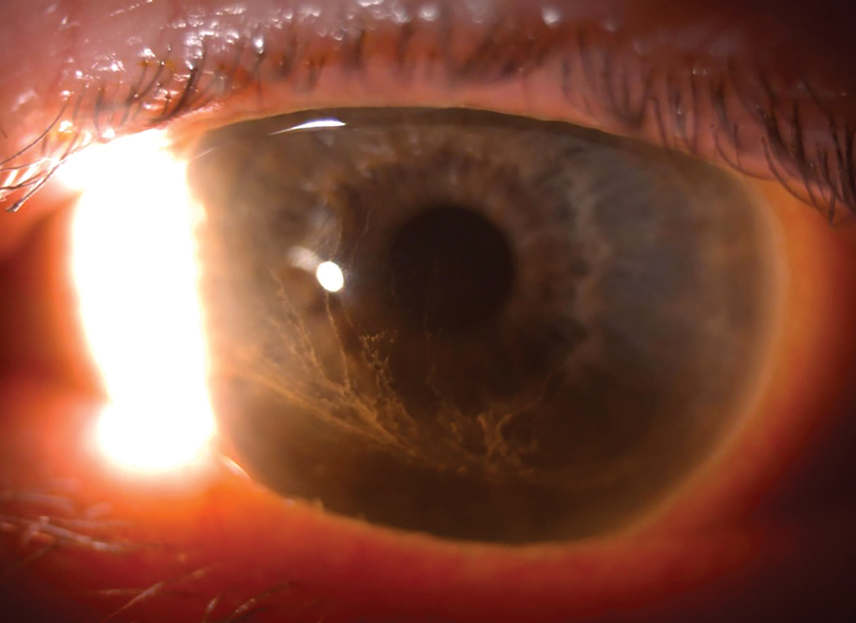 Corneal epithelial deposits encroaching the visual axis, although not visually significant.