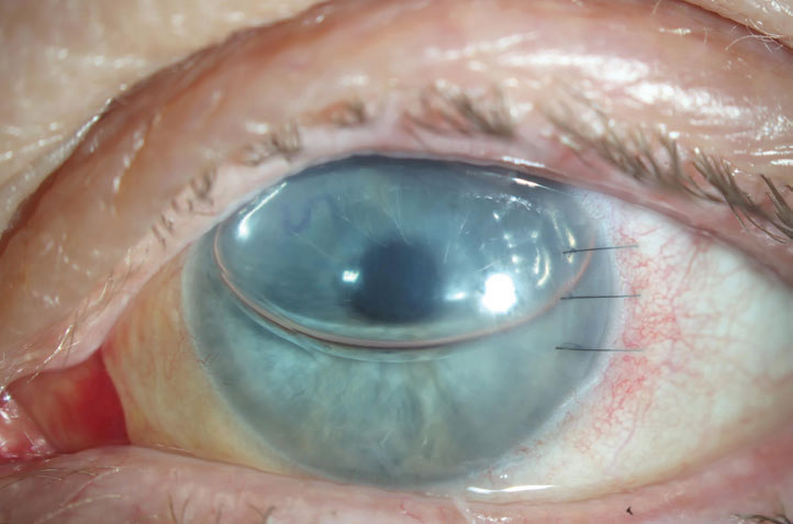 This typical DMEK one-day postoperative appearance has a large gas bubble present in the anterior chamber. When the patient is supine, the gas bubble will press the donor graft into place. The bubble will limit vision to 20/400 or worse until it reabsorbs out of the visual axis.  An “S” stamp, which can be placed by the eye bank upon surgeon request, can also be seen, indicating the graft is in the correct orientation. An inverted “S” would mean the transplant is upside down.
